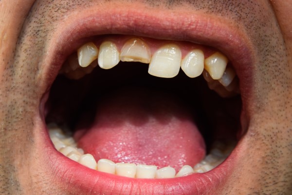 When An Emergency Dentist Will Treat A Broken Tooth