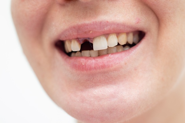 Why You Should Get A Broken Tooth Treated