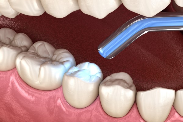 How Safe Is Mercury Free Dentistry?