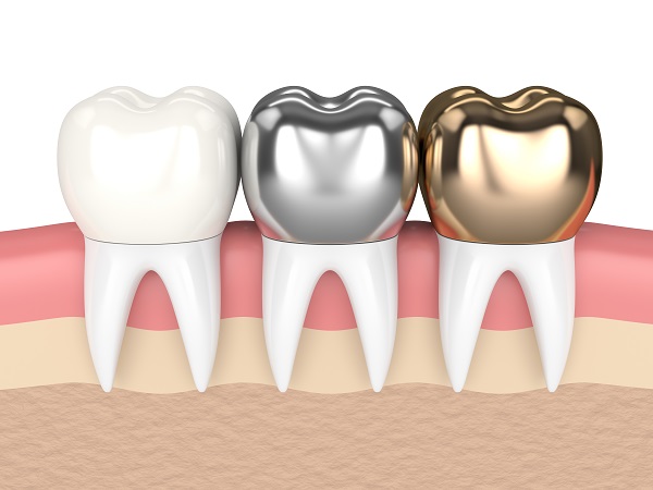 Can A Dental Crown Fall Out?
