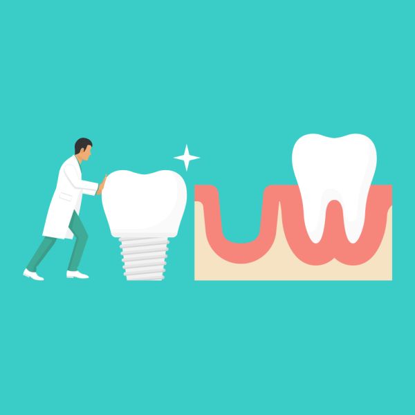 How To Prepare For Dental Implants