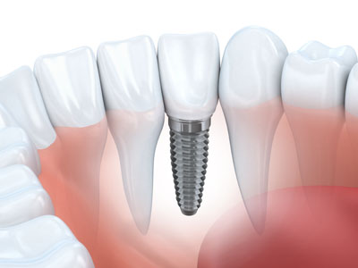 Dental Implants in Troy