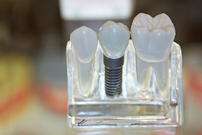 Dental Implants Are A Secure Alternative To Dentures