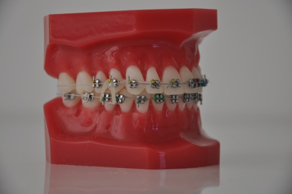 Fastbraces® vs. Traditional Braces - Thanasas Family Dental Care