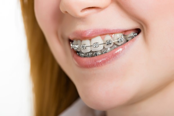 How To Care For Your FastBraces