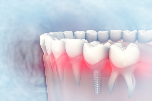 How A Dental Implant Replaces A Missing Tooth