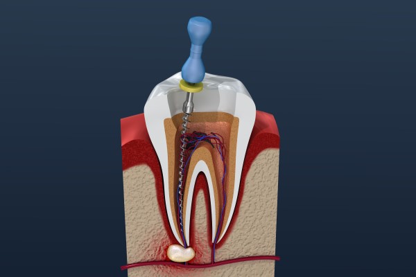 Root Canal Treatment Troy, MI