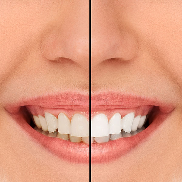 Visit Our Office For A Smile Makeover