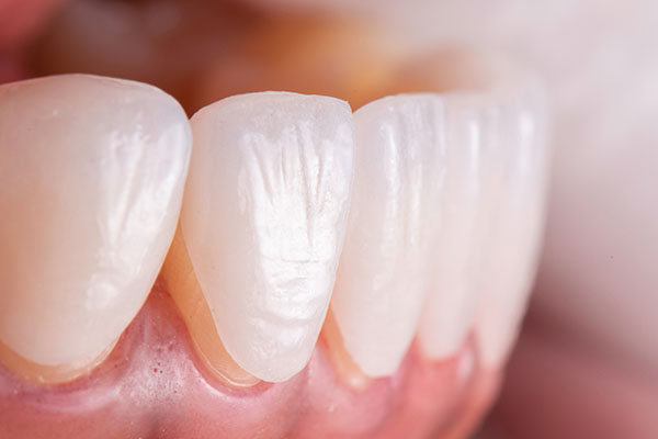 Using Veneers To Close Gaps Between Teeth from Thanasas Family Dental Care in Troy, MI